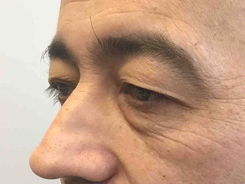 Blepharoplasty Before & After Gallery - Patient 228529 - Image 1