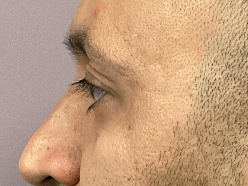 Blepharoplasty Before & After Gallery - Patient 278046 - Image 11