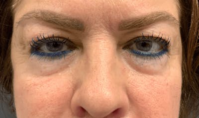 Blepharoplasty Before & After Gallery - Patient 127507 - Image 1