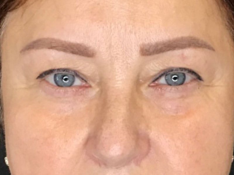 Blepharoplasty Before & After Gallery - Patient 249742 - Image 1
