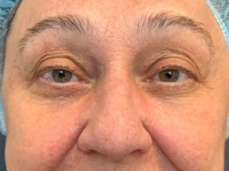 Blepharoplasty Before & After Gallery - Patient 187830 - Image 1