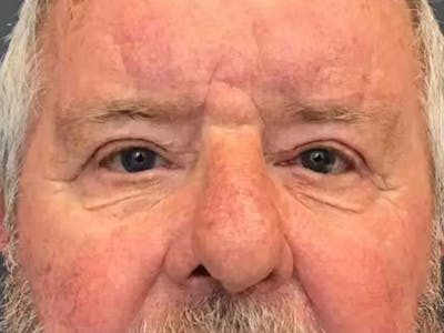 Blepharoplasty Before & After Gallery - Patient 286607 - Image 2