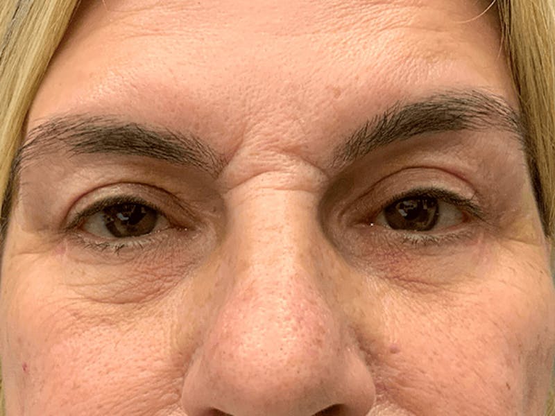 Blepharoplasty Before & After Gallery - Patient 296391 - Image 2