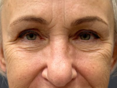 Blepharoplasty Before & After Gallery - Patient 386447 - Image 2