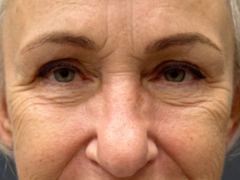 Blepharoplasty Before & After Gallery - Patient 386447 - Image 2