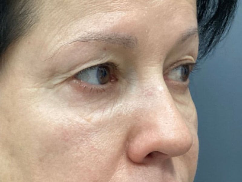 Blepharoplasty Before & After Gallery - Patient 289139 - Image 3