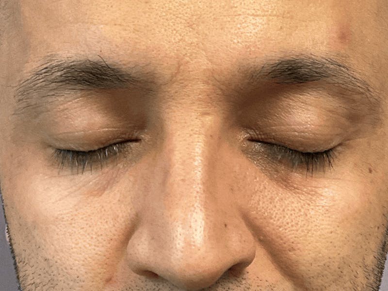 Blepharoplasty Before & After Gallery - Patient 278046 - Image 3