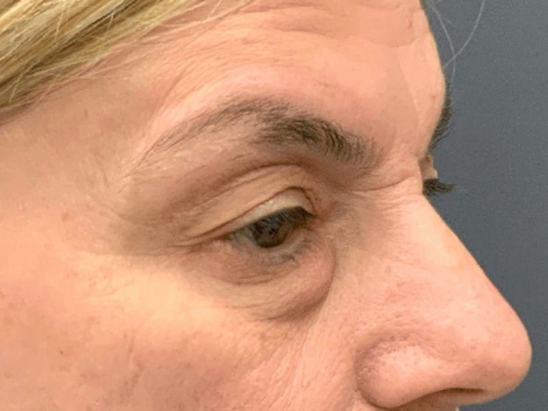 Blepharoplasty Before & After Gallery - Patient 296391 - Image 3