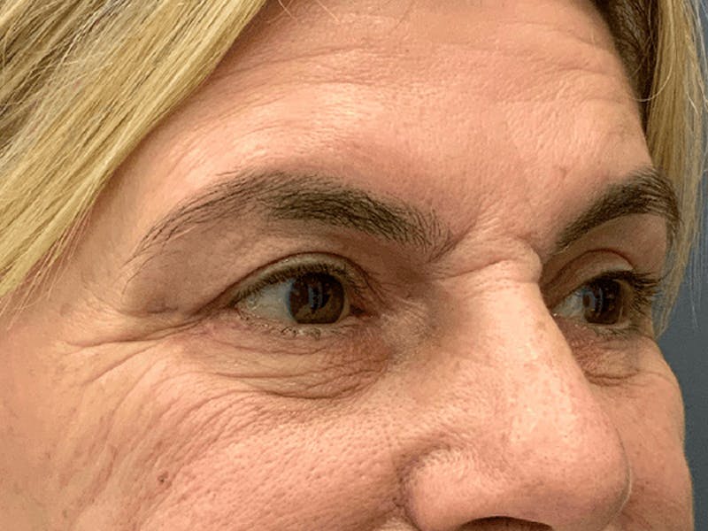 Blepharoplasty Before & After Gallery - Patient 296391 - Image 4