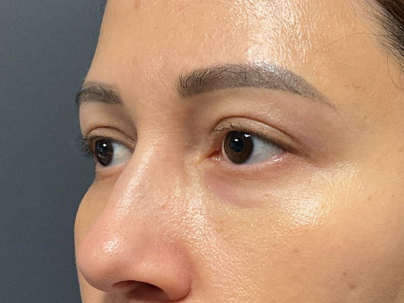 Blepharoplasty Before & After Gallery - Patient 410588 - Image 6