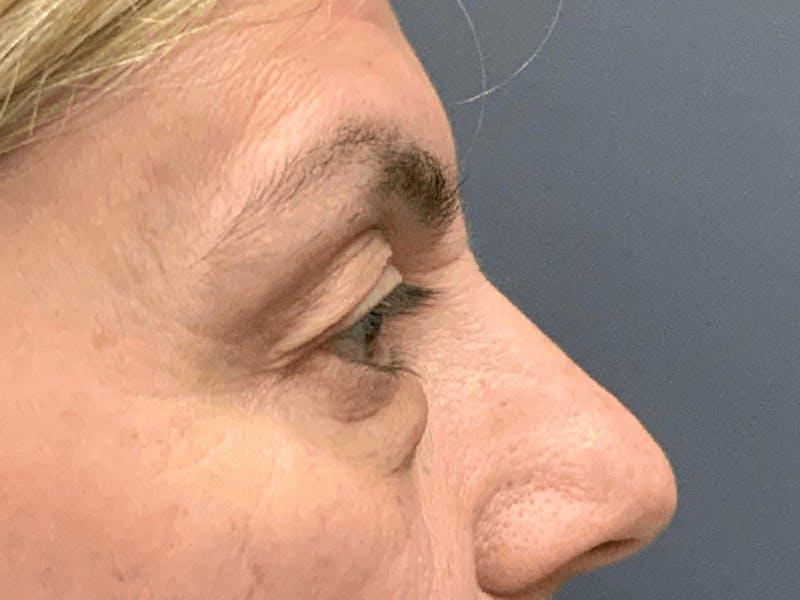 Blepharoplasty Before & After Gallery - Patient 296391 - Image 5