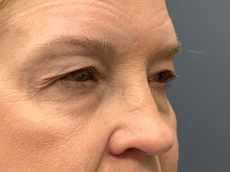 Blepharoplasty Before & After Gallery - Patient 290723 - Image 5