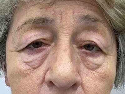 Blepharoplasty Before & After Gallery - Patient 187426 - Image 1