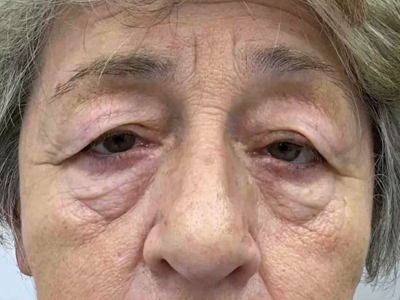 Blepharoplasty Before & After Gallery - Patient 187426 - Image 1