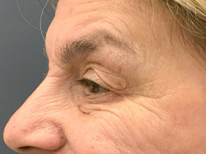 Blepharoplasty Before & After Gallery - Patient 296391 - Image 7