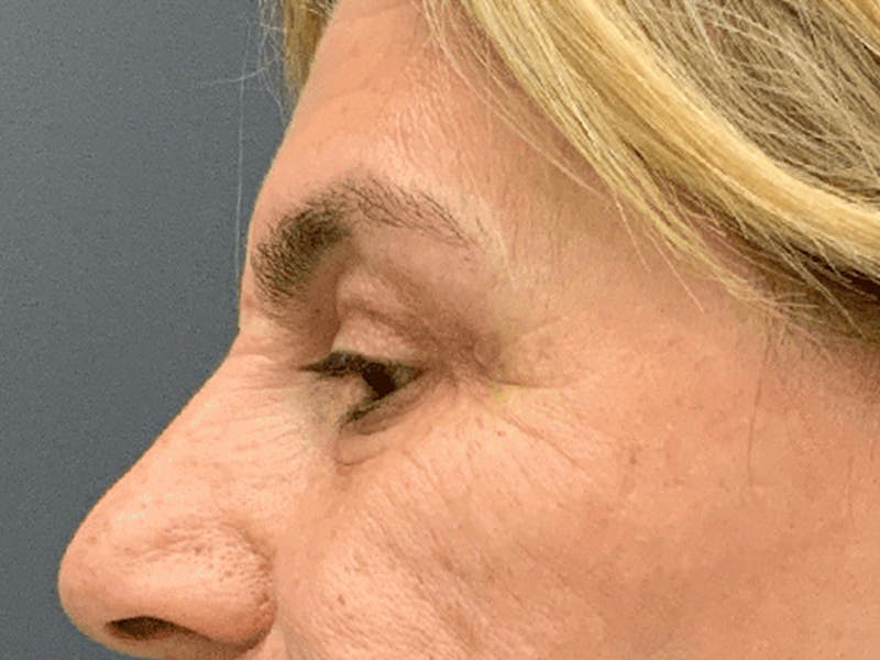 Blepharoplasty Before & After Gallery - Patient 296391 - Image 8
