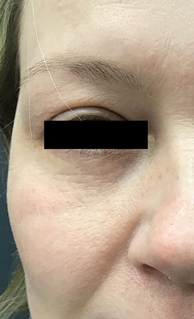 Blepharoplasty Before & After Gallery - Patient 328115 - Image 4