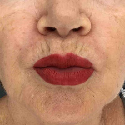 Botox Before & After Gallery - Patient 642585 - Image 1