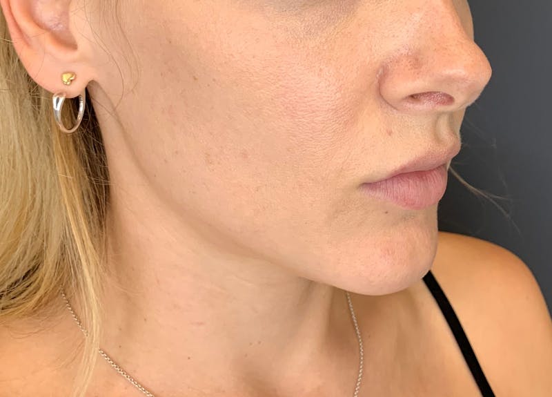 Dermal Fillers Before & After Gallery - Patient 102758 - Image 2