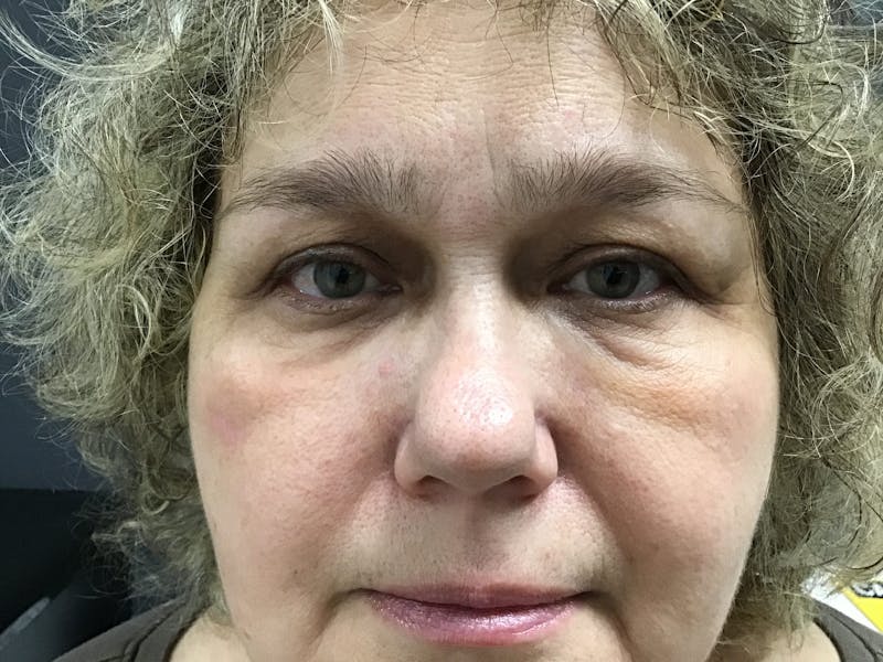 Dermal Fillers Before & After Gallery - Patient 124789 - Image 2