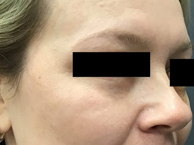Blepharoplasty Before & After Gallery - Patient 328115 - Image 2