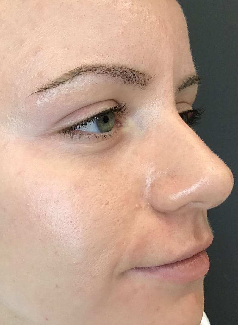 Dermal Fillers Before & After Gallery - Patient 210414 - Image 5