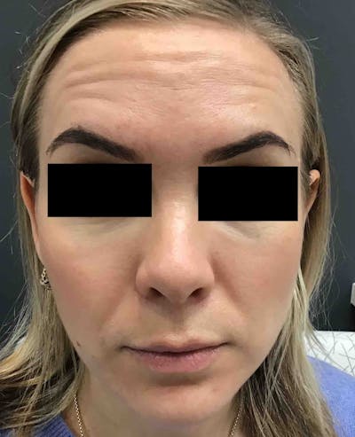 Botox Before & After Gallery - Patient 371778 - Image 1