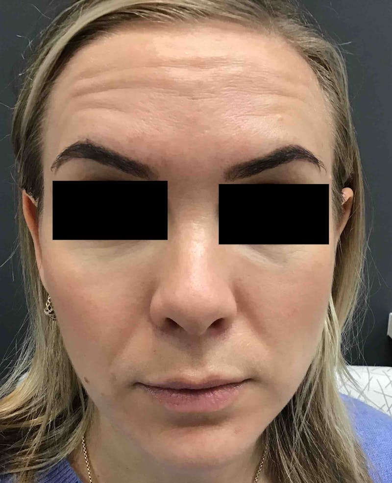 Botox Before & After Gallery - Patient 371778 - Image 1