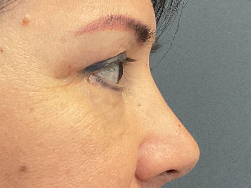 Blepharoplasty Before & After Gallery - Patient 341667 - Image 8