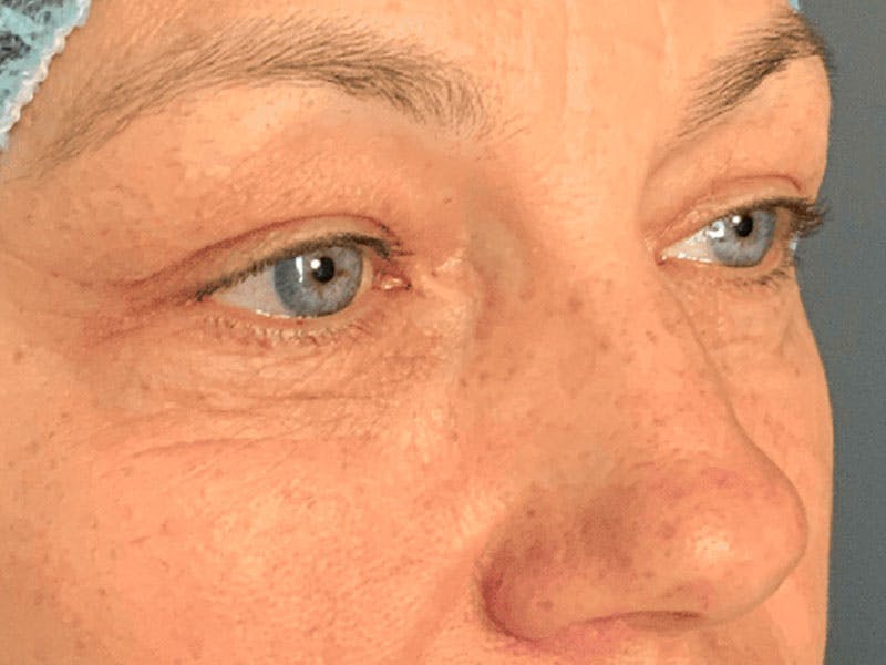 Blepharoplasty Before & After Gallery - Patient 121107 - Image 5