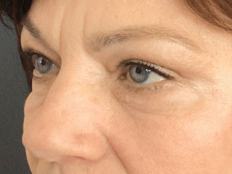 Blepharoplasty Before & After Gallery - Patient 121107 - Image 4
