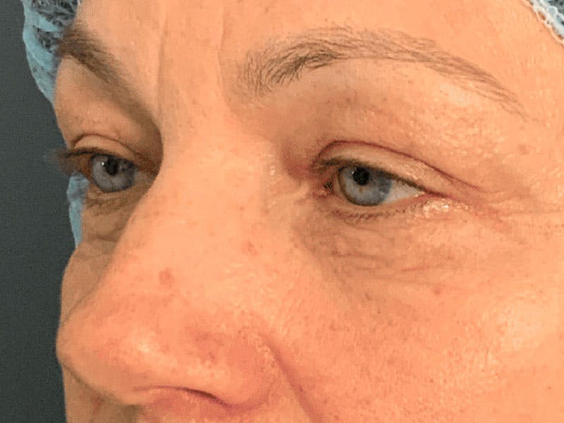 Blepharoplasty Before & After Gallery - Patient 121107 - Image 3