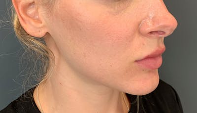 Dermal Fillers Before & After Gallery - Patient 102758 - Image 1