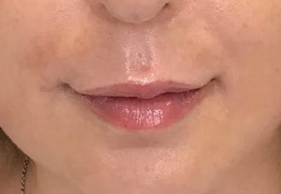 Dermal Fillers Before & After Gallery - Patient 172972 - Image 2