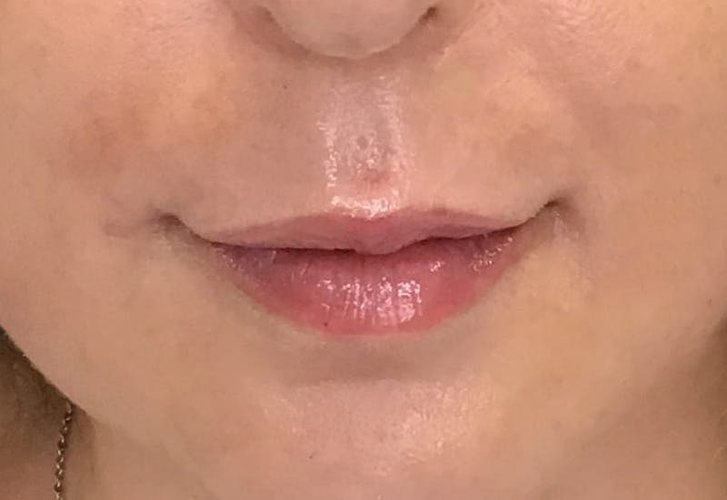 Dermal Fillers Before & After Gallery - Patient 172972 - Image 2