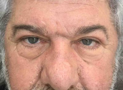 Blepharoplasty Before & After Gallery - Patient 254621 - Image 2