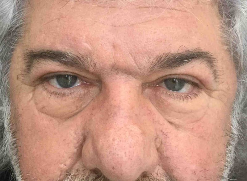 Blepharoplasty Before & After Gallery - Patient 254621 - Image 2