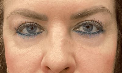 Blepharoplasty Before & After Gallery - Patient 127507 - Image 2