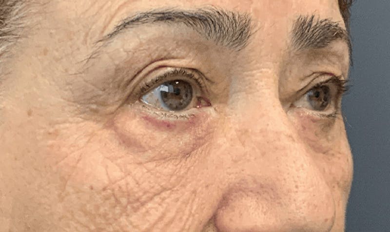 Blepharoplasty Before & After Gallery - Patient 867382 - Image 3