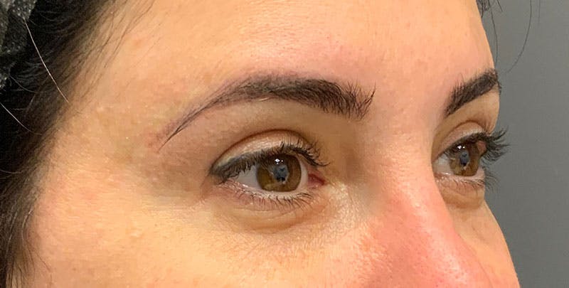 Blepharoplasty Before & After Gallery - Patient 156052 - Image 3