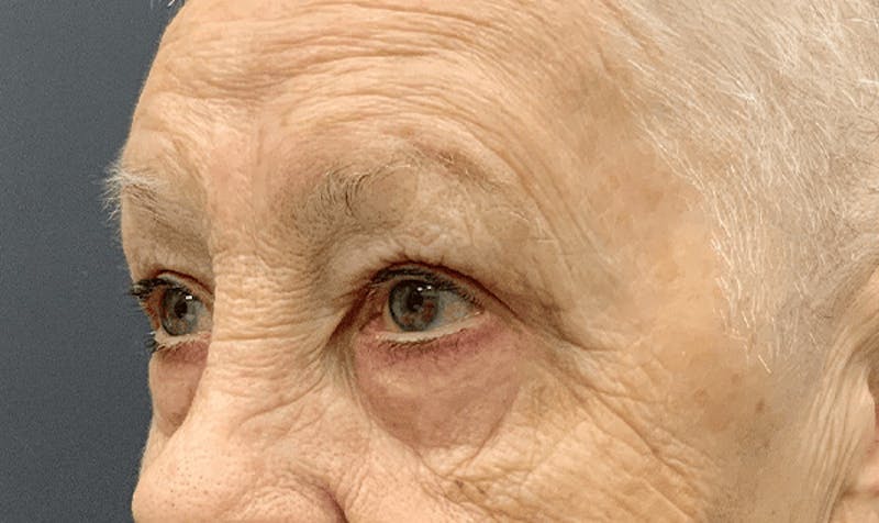 Blepharoplasty Before & After Gallery - Patient 355328 - Image 8