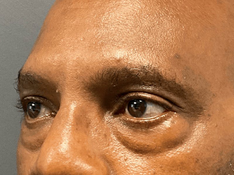 Blepharoplasty Before & After Gallery - Patient 326511 - Image 7