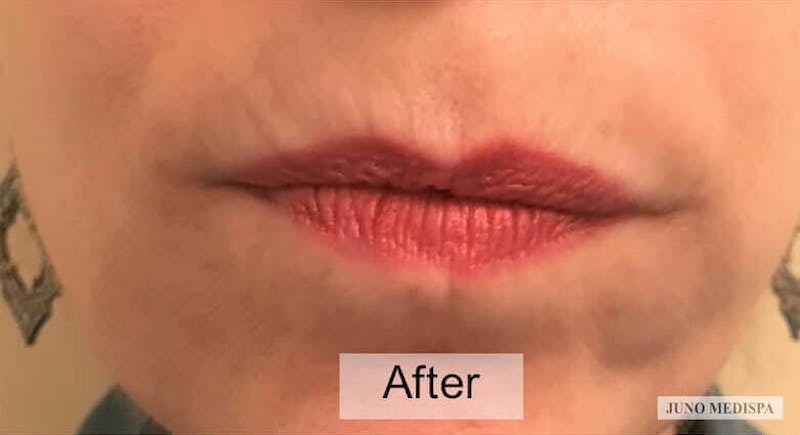 Botox Before & After Gallery - Patient 134549 - Image 2