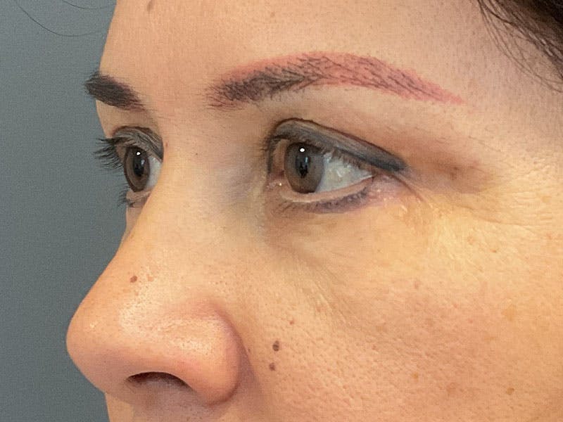 Blepharoplasty Before & After Gallery - Patient 341667 - Image 4