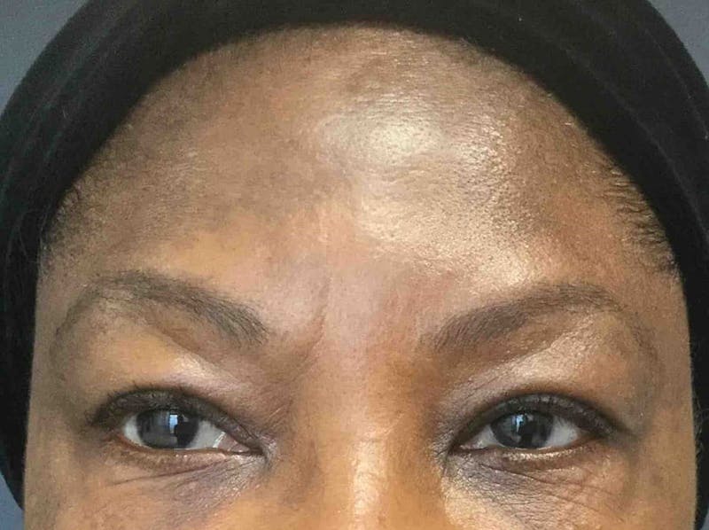 Botox Before & After Gallery - Patient 303794 - Image 4