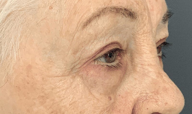 Blepharoplasty Before & After Gallery - Patient 355328 - Image 4