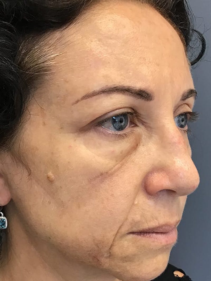 Dermal Fillers Before & After Gallery - Patient 129971 - Image 7