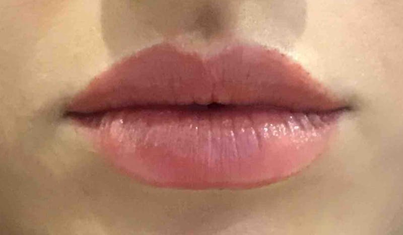 Dermal Fillers Before & After Gallery - Patient 846868 - Image 4