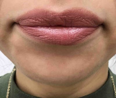 Botox Before & After Gallery - Patient 261799 - Image 2