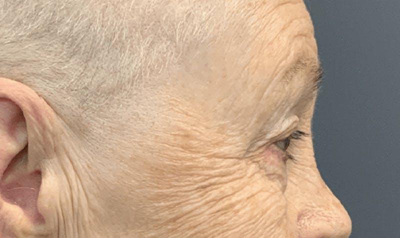 Blepharoplasty Before & After Gallery - Patient 355328 - Image 5